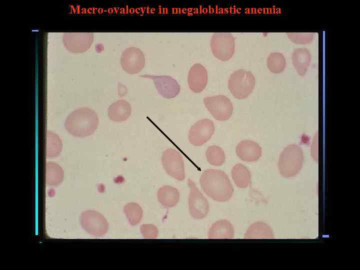Macro-ovalocyte in megaloblastic anemia 