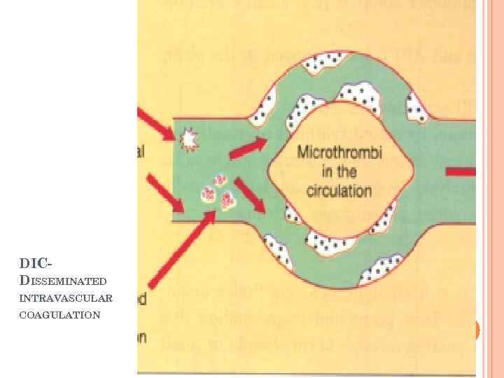 DICDISSEMINATED INTRAVASCULAR COAGULATION 