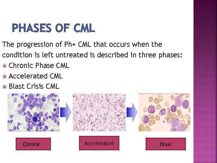 PHASES OF CML The progression of Ph+ CML that occurs when the condition is
