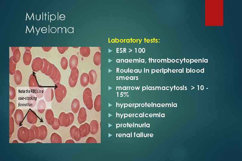 Multiple Myeloma Laboratory tests: ESR > 100 anaemia, thrombocytopenia Rouleau in peripheral blood smears
