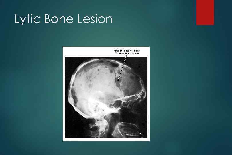 Lytic Bone Lesion 