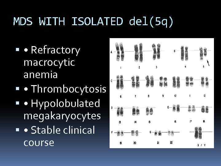 MDS WITH ISOLATED del(5 q) • Refractory macrocytic anemia • Thrombocytosis • Hypolobulated megakaryocytes