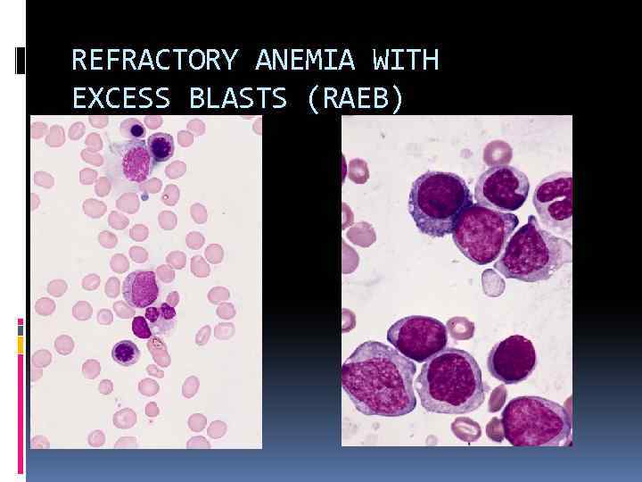 REFRACTORY ANEMIA WITH EXCESS BLASTS (RAEB) 