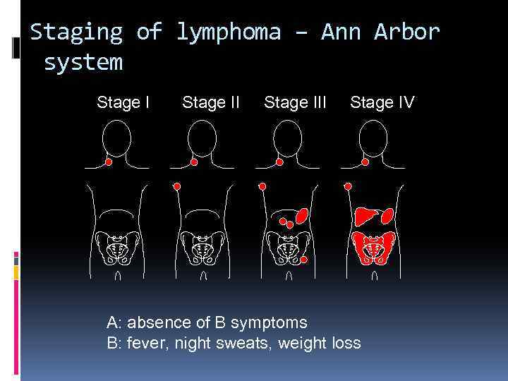 Staging of lymphoma – Ann Arbor system Stage III Stage IV A: absence of