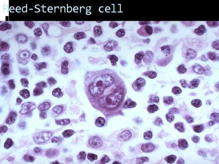 Reed-Sternberg cell 