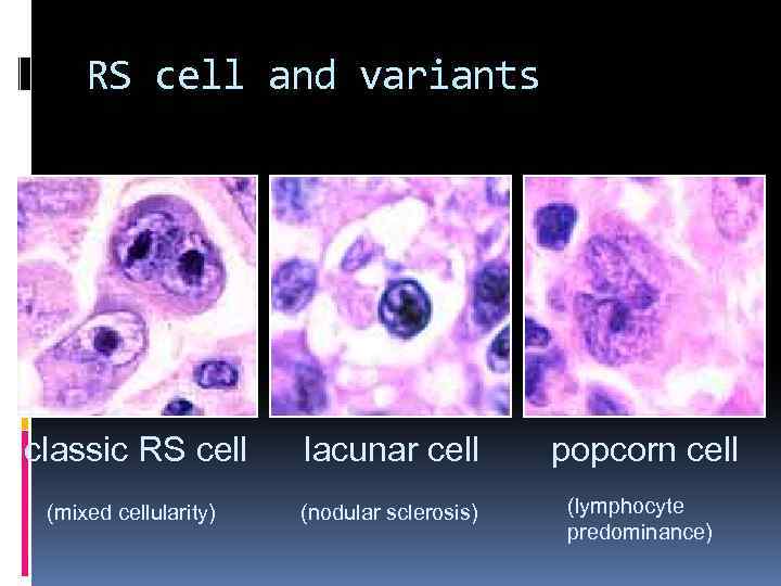 RS cell and variants classic RS cell lacunar cell popcorn cell (mixed cellularity) (nodular