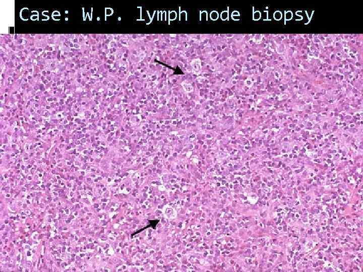 Case: W. P. lymph node biopsy 