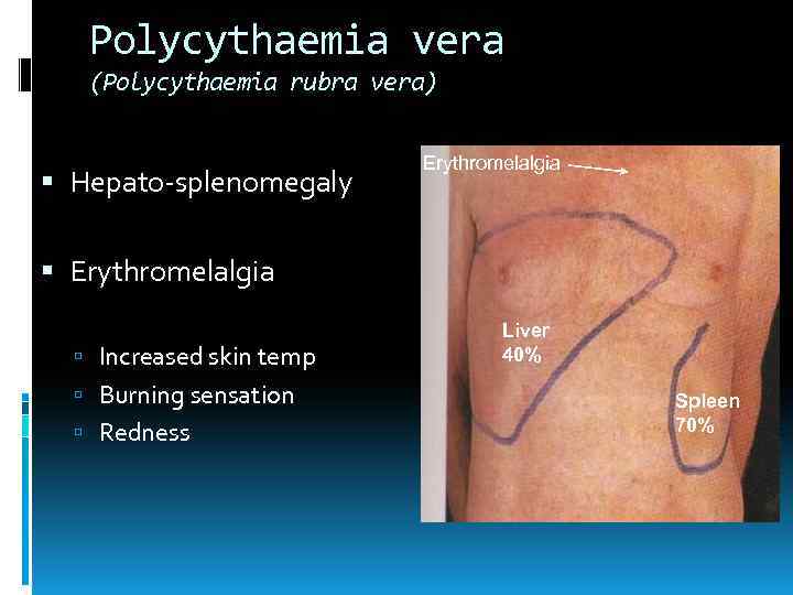 Polycythaemia vera (Polycythaemia rubra vera) Hepato-splenomegaly Erythromelalgia Increased skin temp Burning sensation Redness Liver