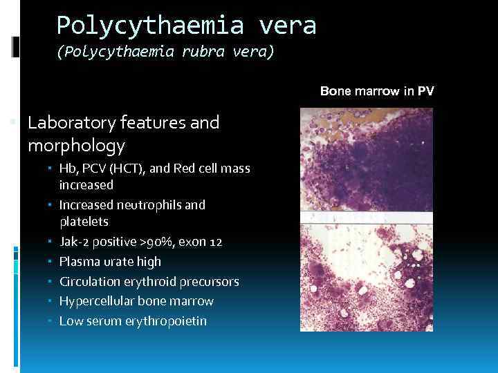 Polycythaemia vera (Polycythaemia rubra vera) Bone marrow in PV Laboratory features and morphology Hb,