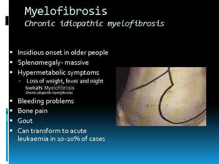 Myelofibrosis Chronic idiopathic myelofibrosis Insidious onset in older people Splenomegaly- massive Hypermetabolic symptoms Loss