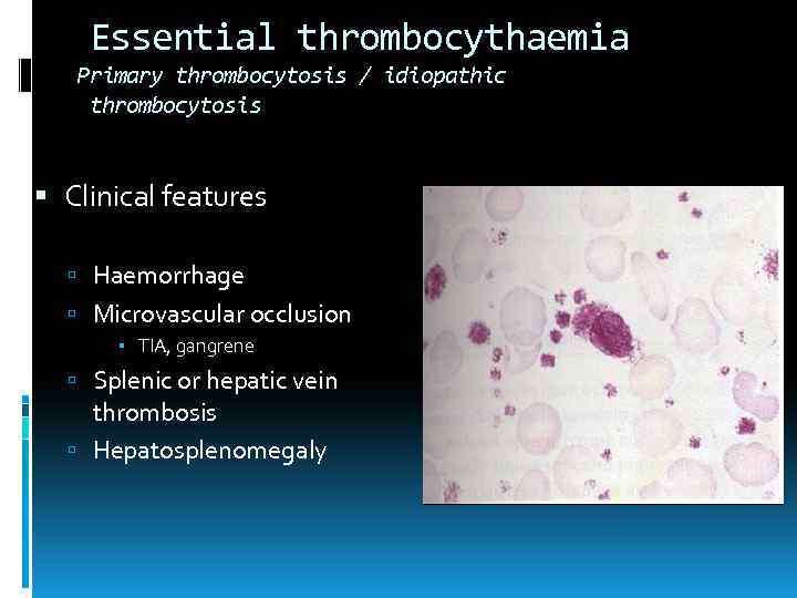 Essential thrombocythaemia Primary thrombocytosis / idiopathic thrombocytosis Clinical features Haemorrhage Microvascular occlusion TIA, gangrene