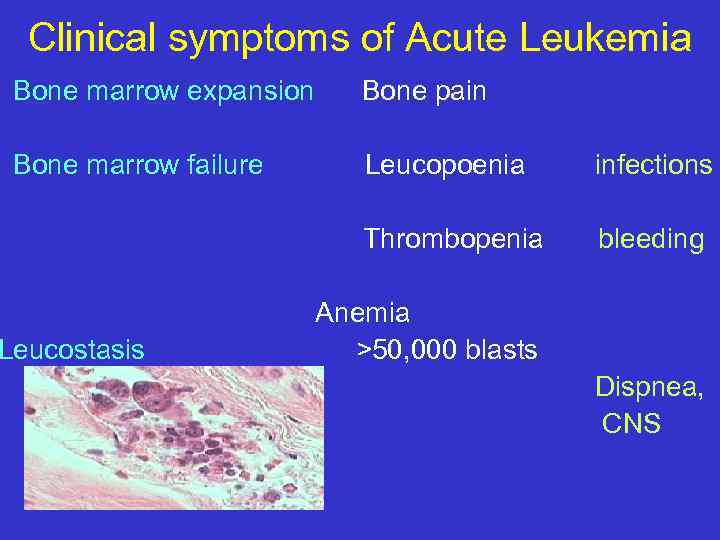 Clinical symptoms of Acute Leukemia Bone marrow expansion Bone pain Bone marrow failure Leucopoenia