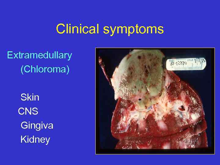 Clinical symptoms Extramedullary (Chloroma) Skin CNS Gingiva Kidney 