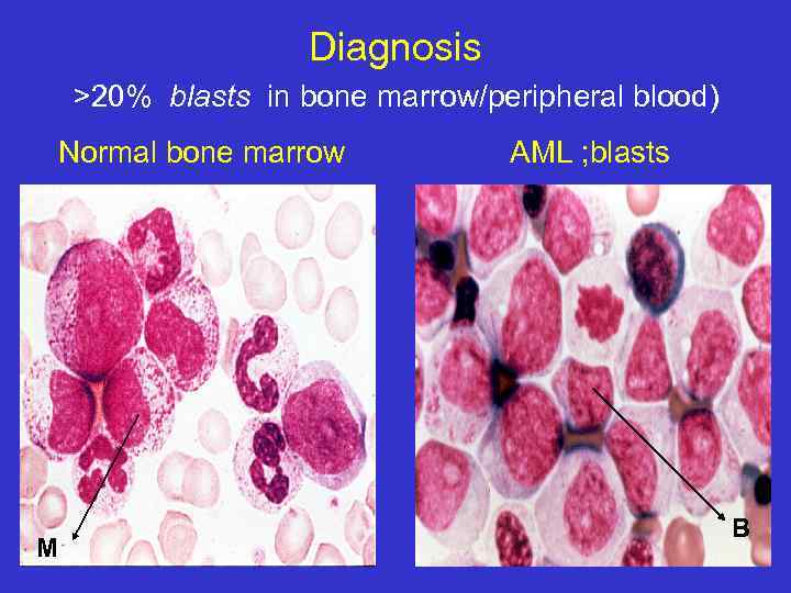 Diagnosis >20% blasts in bone marrow/peripheral blood) Normal bone marrow M AML ; blasts