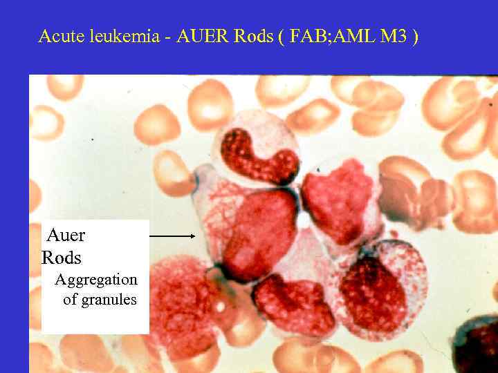 Acute leukemia - AUER Rods ( FAB; AML M 3 ) Auer Rods Aggregation