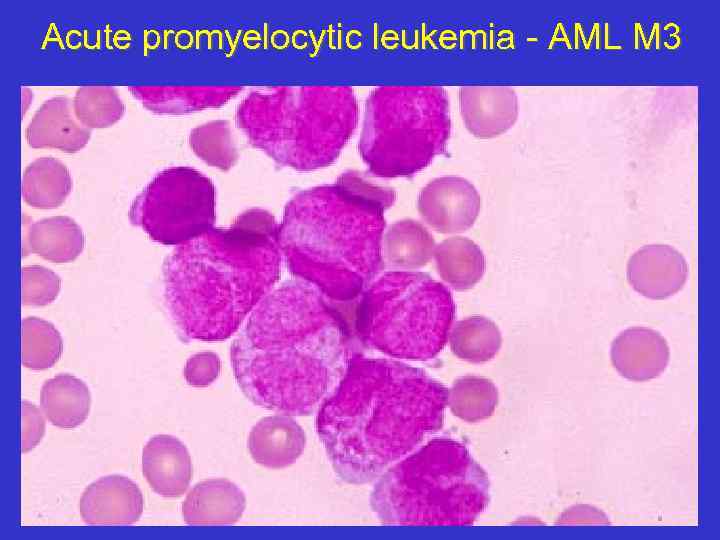 Acute promyelocytic leukemia - AML M 3 