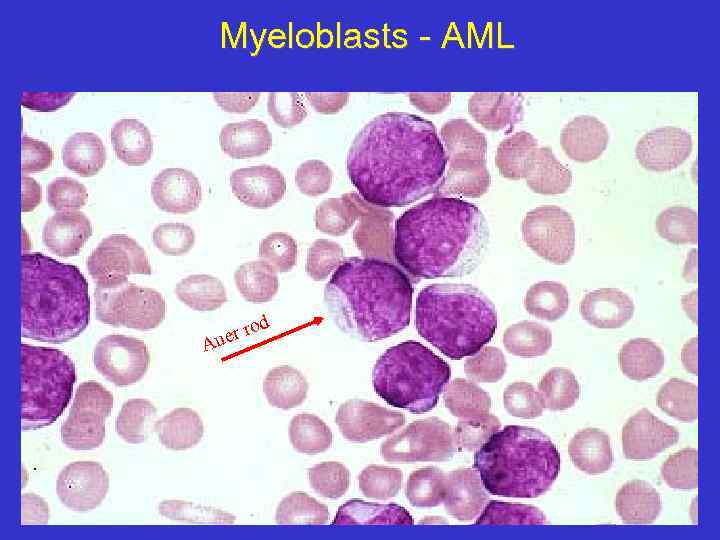 Myeloblasts - AML d ro uer A 