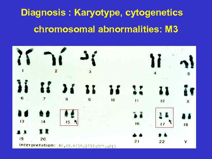 Diagnosis : Karyotype, cytogenetics chromosomal abnormalities: M 3 