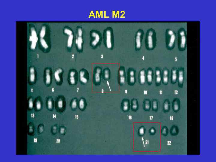 AML M 2 