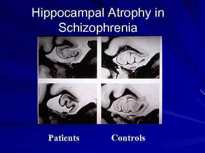 Hippocampal Atrophy in Schizophrenia Patients Controls 