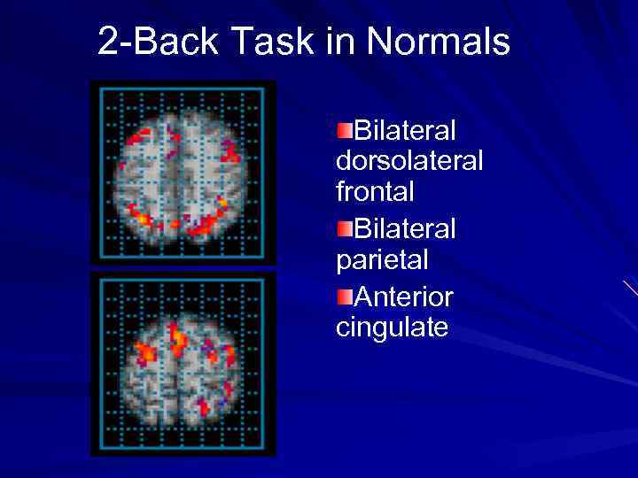 2 -Back Task in Normals Bilateral dorsolateral frontal Bilateral parietal Anterior cingulate 