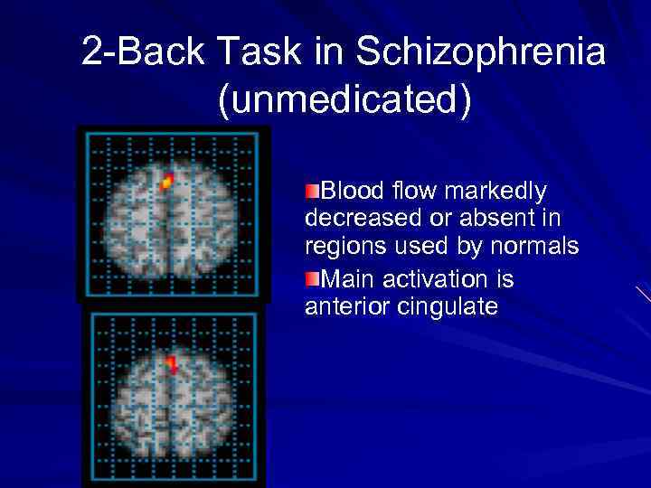 2 -Back Task in Schizophrenia (unmedicated) Blood flow markedly decreased or absent in regions