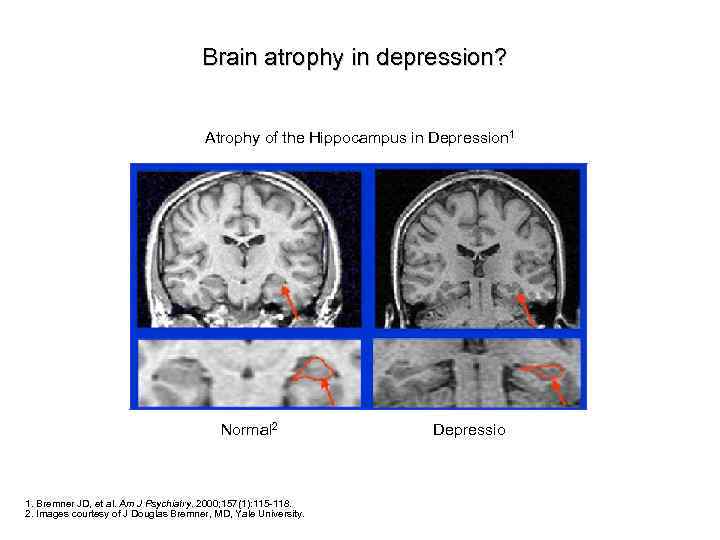 Brain atrophy in depression? Atrophy of the Hippocampus in Depression 1 Normal 2 1.