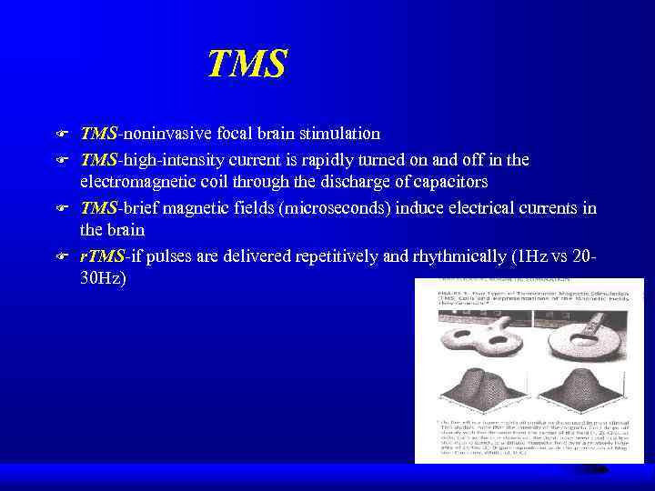 TMS F F TMS-noninvasive focal brain stimulation TMS-high-intensity current is rapidly turned on and