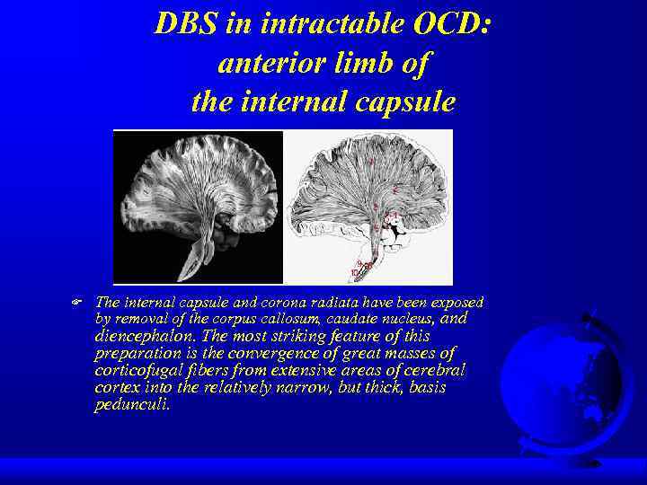 DBS in intractable OCD: anterior limb of the internal capsule F The internal capsule