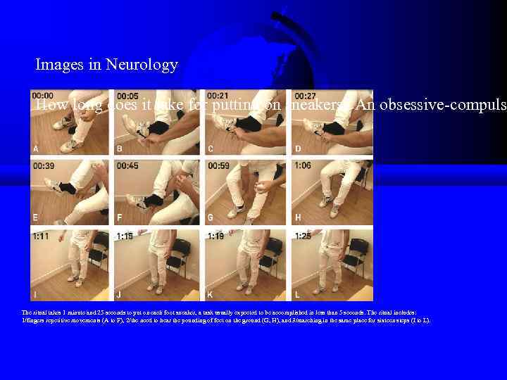 Images in Neurology How long does it take for putting on sneakers? An obsessive-compuls