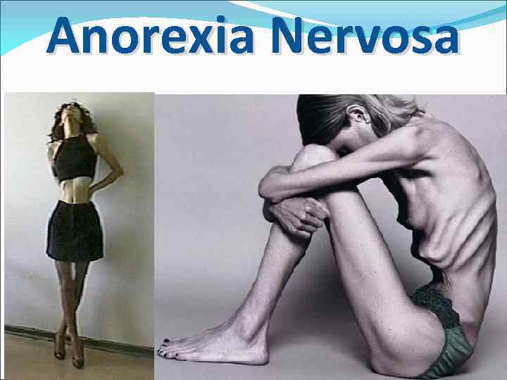 Anorexia Nervosa 