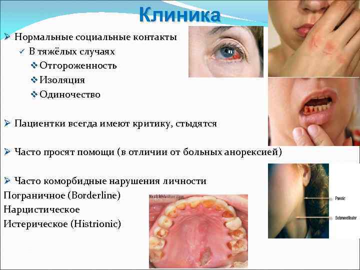 Клиника Ø Нормальные социальные контакты ü В тяжёлых случаях v Отгороженность v Изоляция v