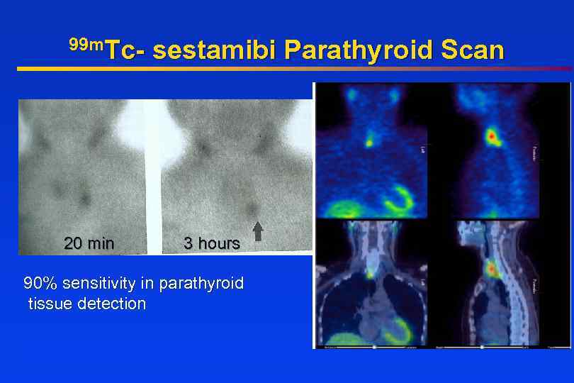 99 m. Tc- 20 min sestamibi Parathyroid Scan 3 hours 90% sensitivity in parathyroid