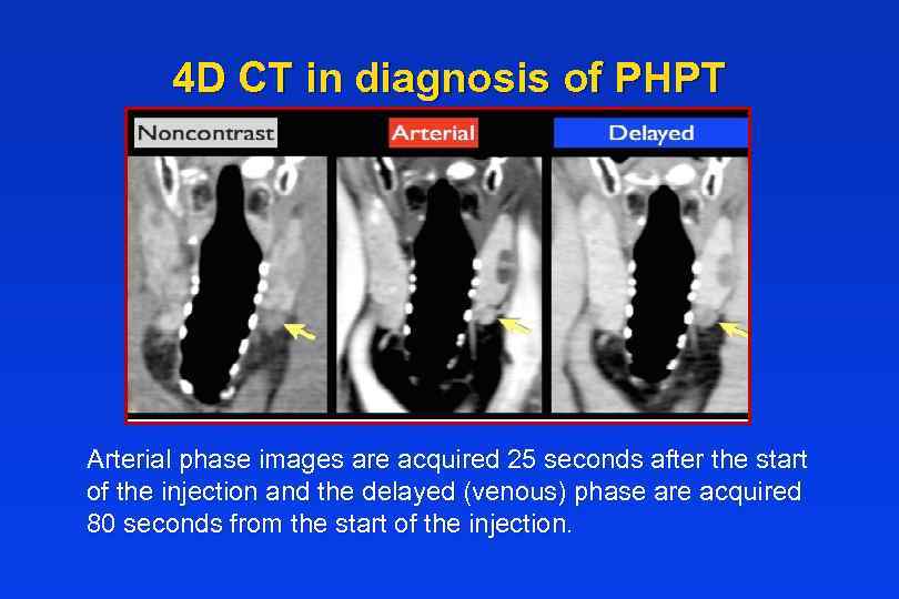 4 D CT in diagnosis of PHPT Arterial phase images are acquired 25 seconds