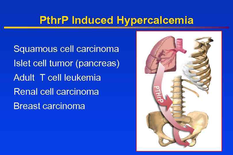 Pthr. P Induced Hypercalcemia Squamous cell carcinoma Islet cell tumor (pancreas) Adult T cell