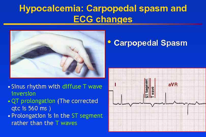 Hypocalcemia: Carpopedal spasm and ECG changes • Carpopedal Spasm • Sinus rhythm with diffuse