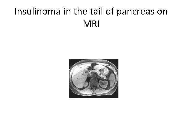 Insulinoma in the tail of pancreas on MRI 