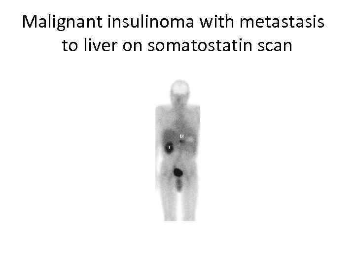 Malignant insulinoma with metastasis to liver on somatostatin scan 