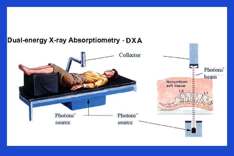 Dual-energy X-ray Absorptiometry Collector Photons’ beam Photons’ source 