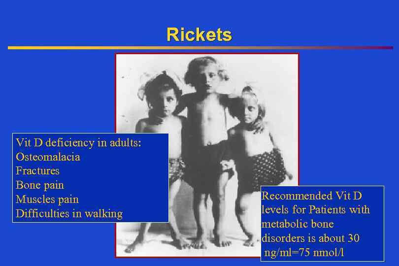 Rickets Vit D deficiency in adults: Osteomalacia Fractures Bone pain Muscles pain Difficulties in