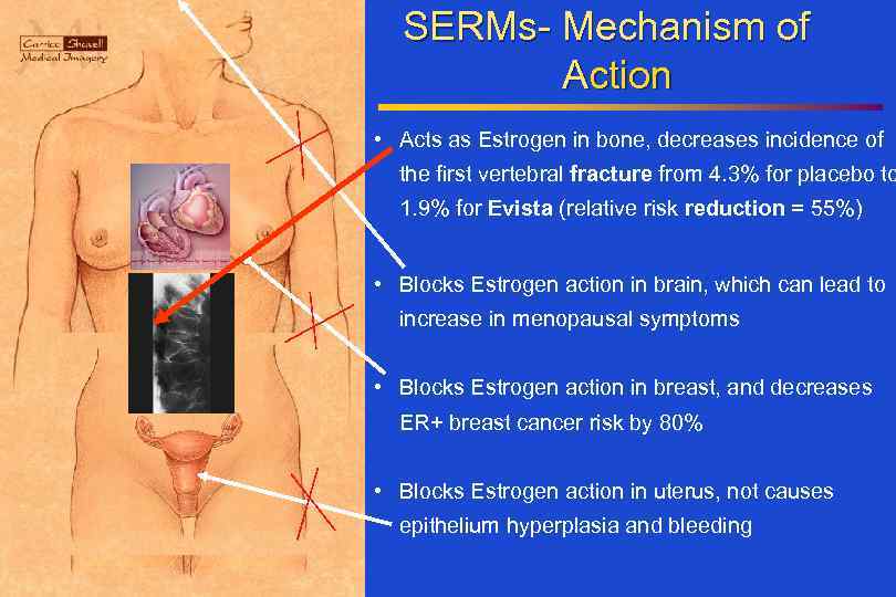 SERMs- Mechanism of Action • Acts as Estrogen in bone, decreases incidence of the