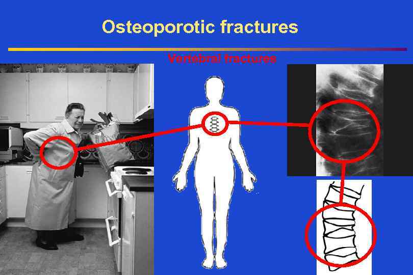 Osteoporotic fractures Vertebral fractures 