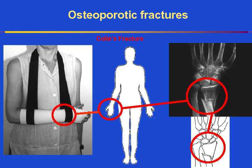Osteoporotic fractures Colle’s Fracture 