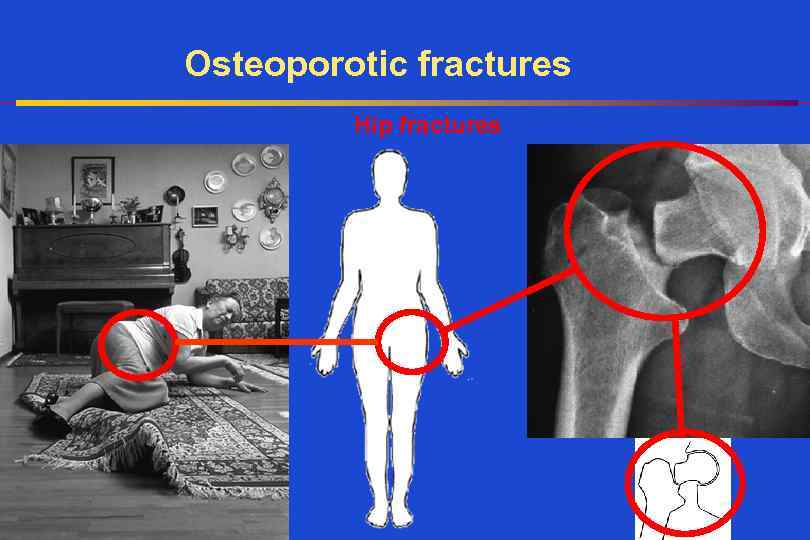 Osteoporotic fractures Hip fractures 