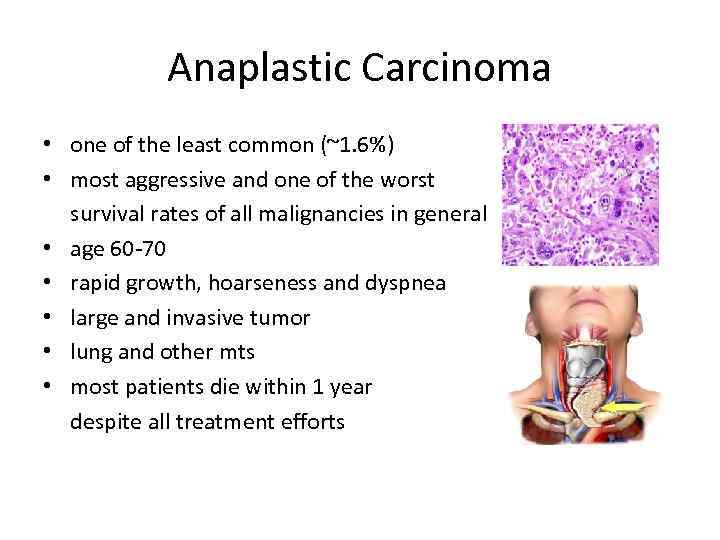 Anaplastic Carcinoma • one of the least common (~1. 6%) • most aggressive and