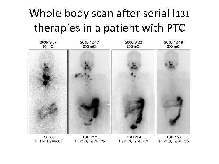 Whole body scan after serial I 131 therapies in a patient with PTC 