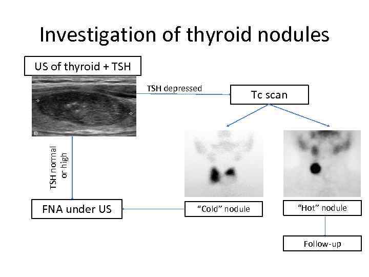 Investigation of thyroid nodules US of thyroid + TSH Tc scan TSH normal or