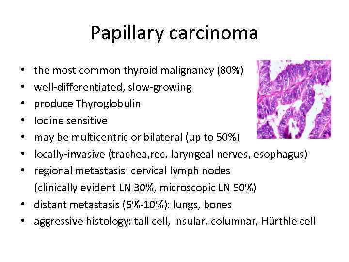 Papillary carcinoma • the most common thyroid malignancy (80%) • well-differentiated, slow-growing • produce