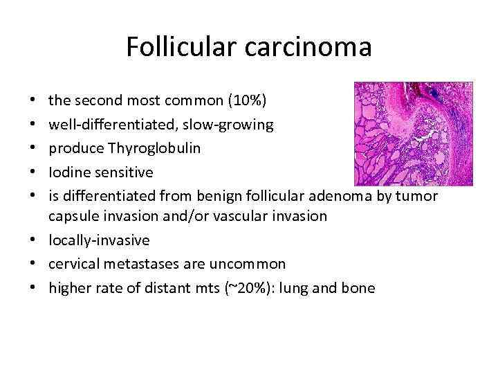Follicular carcinoma the second most common (10%) well-differentiated, slow-growing produce Thyroglobulin Iodine sensitive is