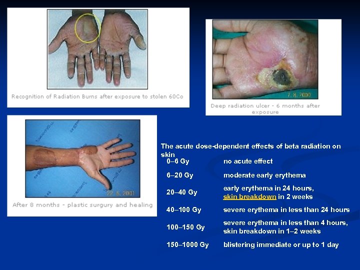 The acute dose-dependent effects of beta radiation on skin 0– 6 Gy no acute